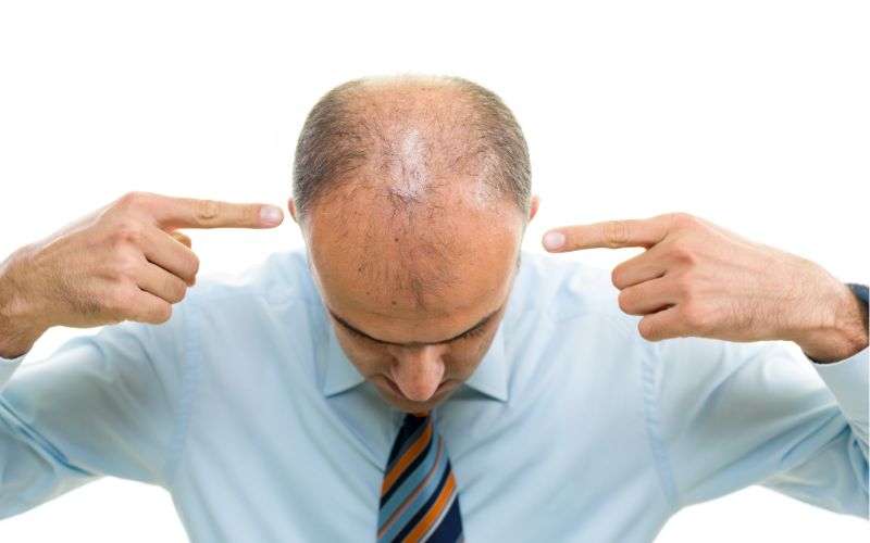 How Do You Know If Hair Loss Is Hormonal?